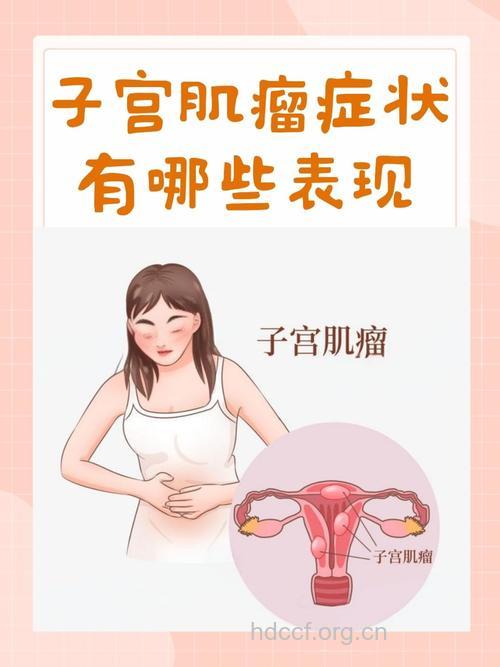 子宫肌瘤症状特征是什么
