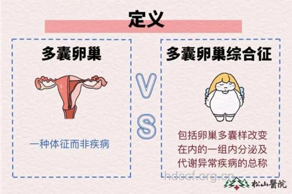 多囊卵巢综合征和内分泌不孕不育的关系