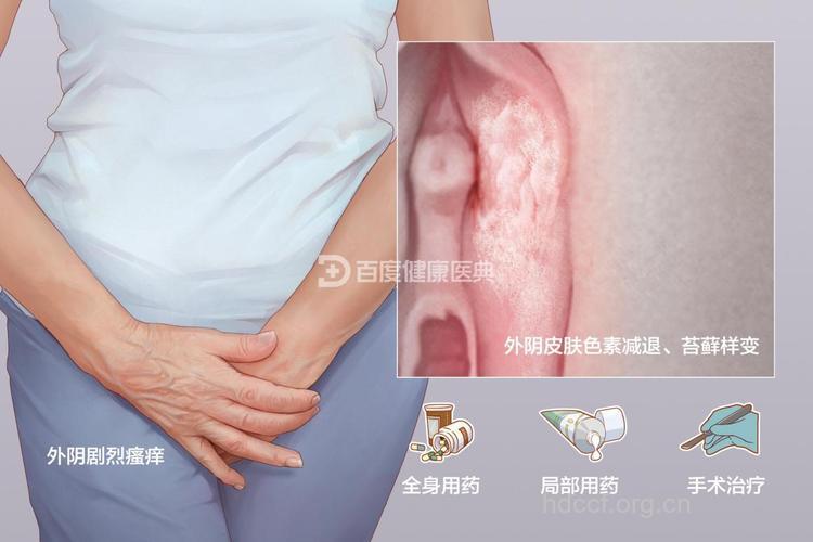 疾病百科 女性外阴白斑是什么病