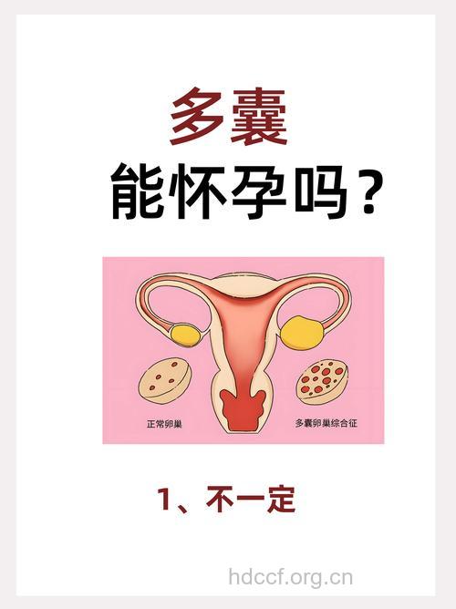 多囊卵巢综合症能自然受孕吗