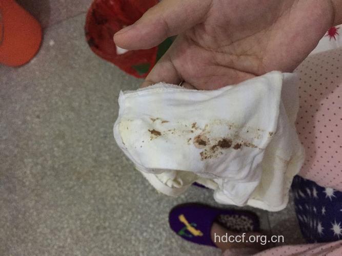 人流后有褐色分泌物 应即时检查排除感染