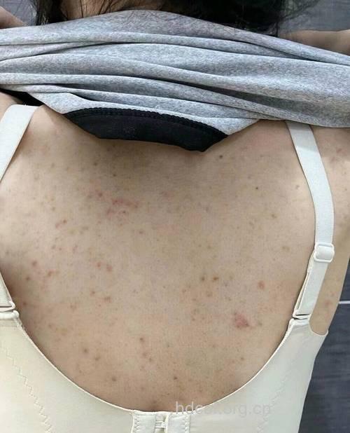 背部长了很多痘痘是什么原因 是它们惹的祸