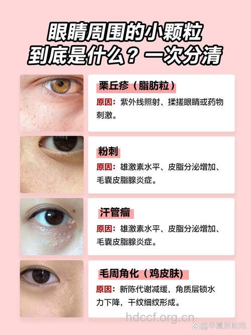 眼周脂肪粒太碍眼 五招教你轻松祛除