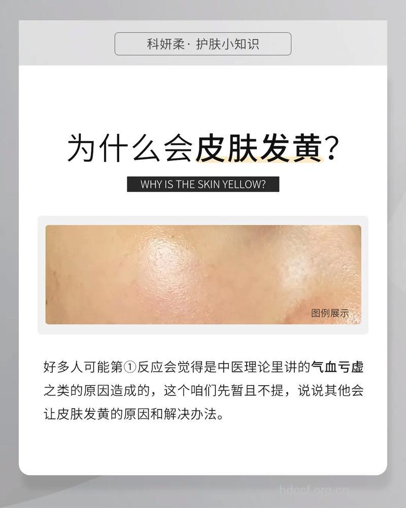 为什么皮肤会越来越黄 多半是这些原因