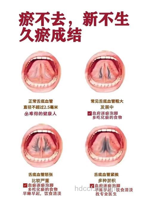 气滞血瘀怎么排出瘀血 试试这些方法