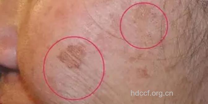 内分泌失调易长斑 7大食疗祛斑润肤