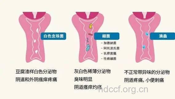 外阴瘙痒小心外阴血吸虫病 外阴血吸虫病是什么