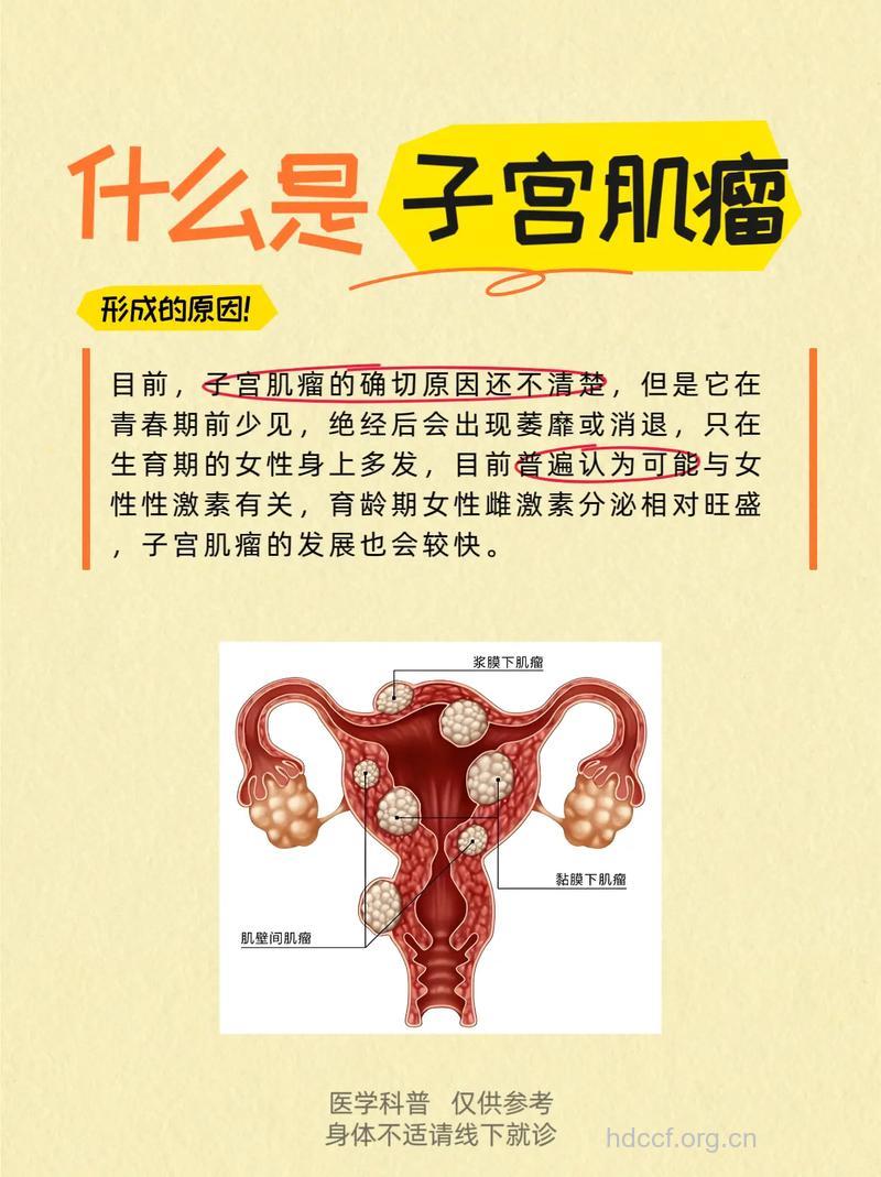 子宫肌瘤的五大症状