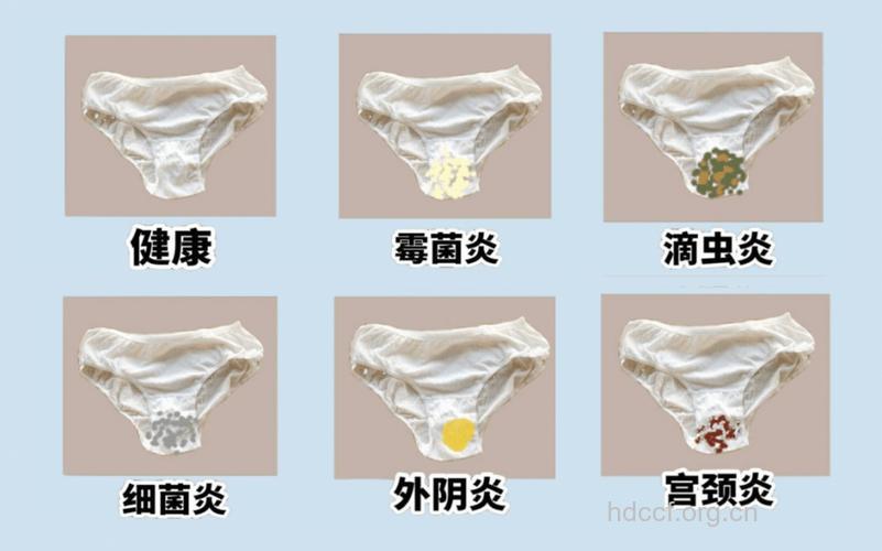 外阴瘙痒 女人外阴瘙痒的十大诱因