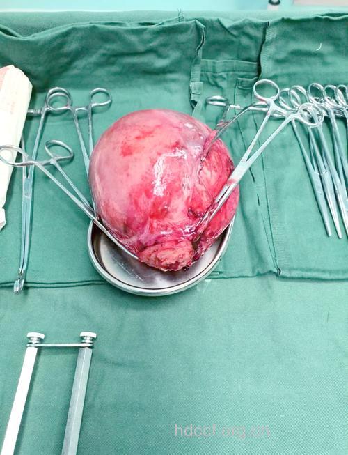 得了子宫肌瘤是什么样的呢