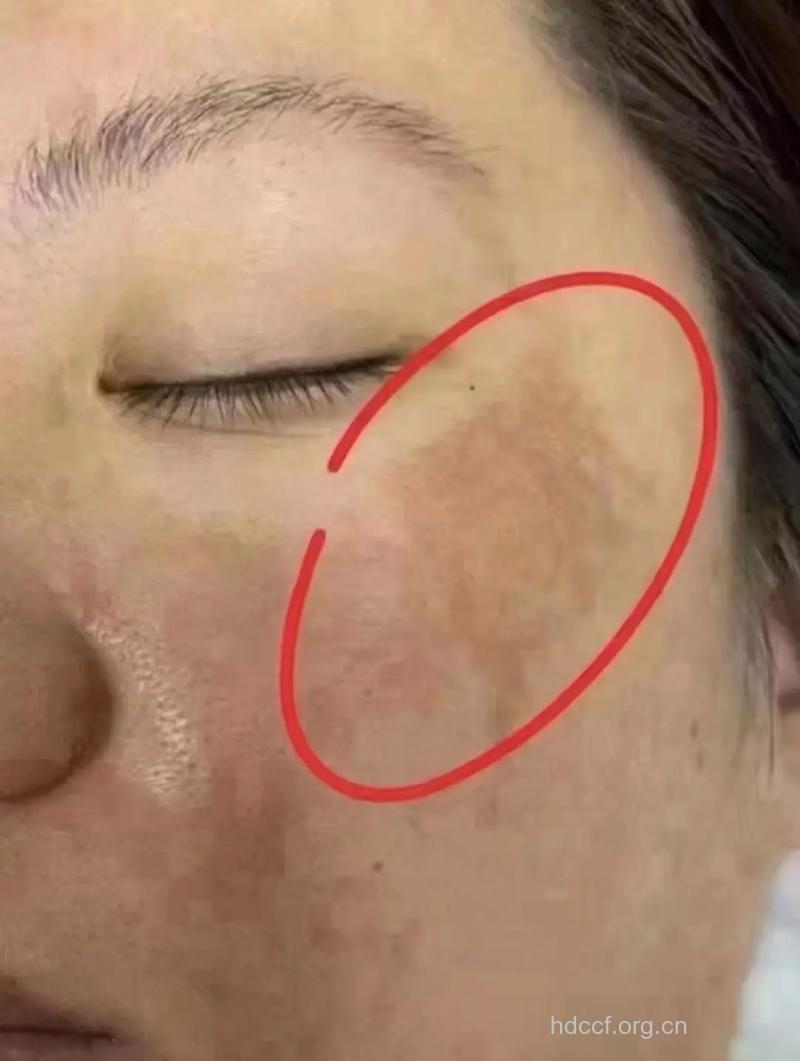 女人脸上的褐斑是子宫肌瘤的症状吗