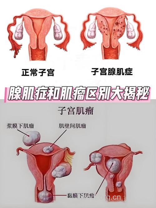 子宫肌瘤女性与正常女性有的区别