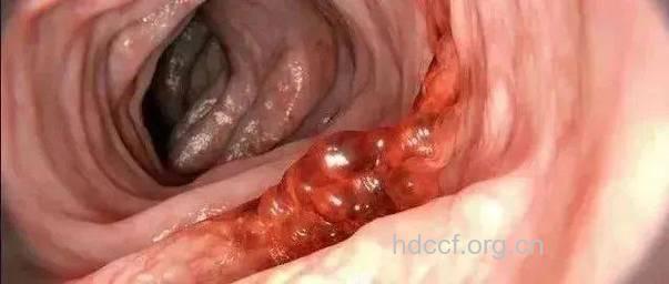 阴道太干危害多 女人为了幸福要为它保湿