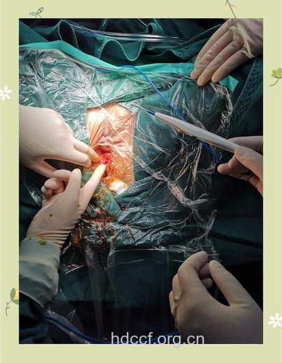 处女膜修复过程是怎么样的