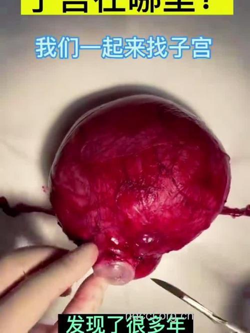 突然发胖原来是子宫肌瘤