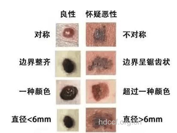 外阴长痣怎么回事 小心变恶性肿瘤