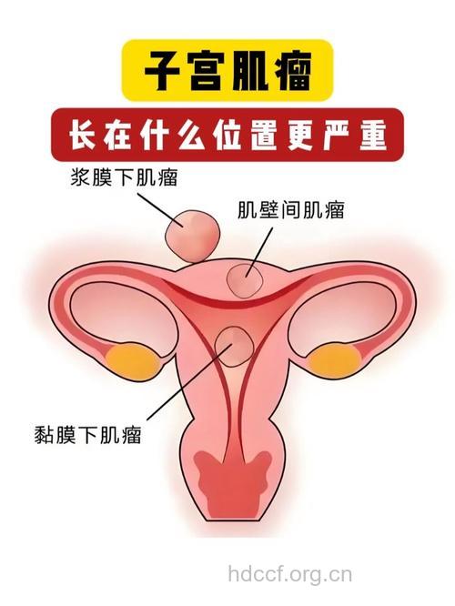 子宫肌瘤的常发部位在哪里呢