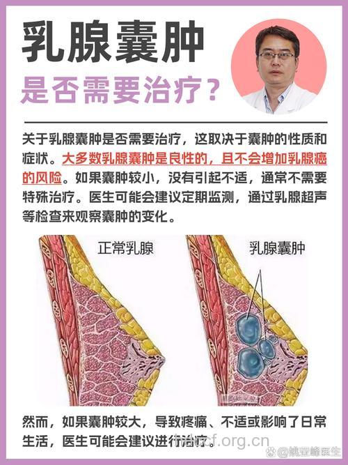 乳腺囊肿会自愈吗 需要手术治疗吗