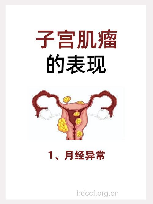子宫肌瘤的典型症状是什么