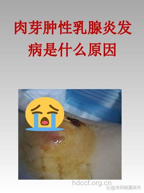 肉芽肿性乳腺炎治不好还会复发 这是真的吗？