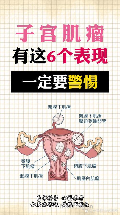 子宫肌瘤临床症状包括哪些