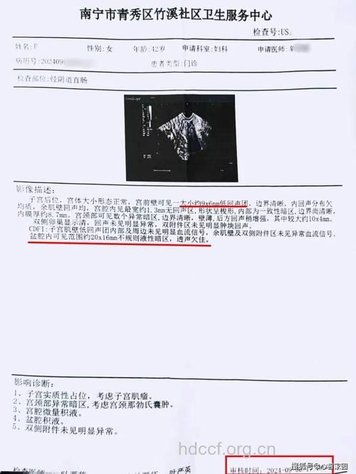 子宫肌瘤有哪些诊断依据