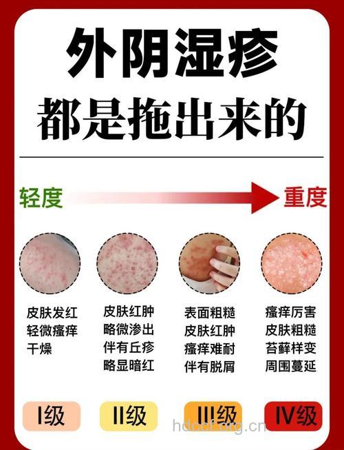 女性体内湿气多 易出现3类妇科问题