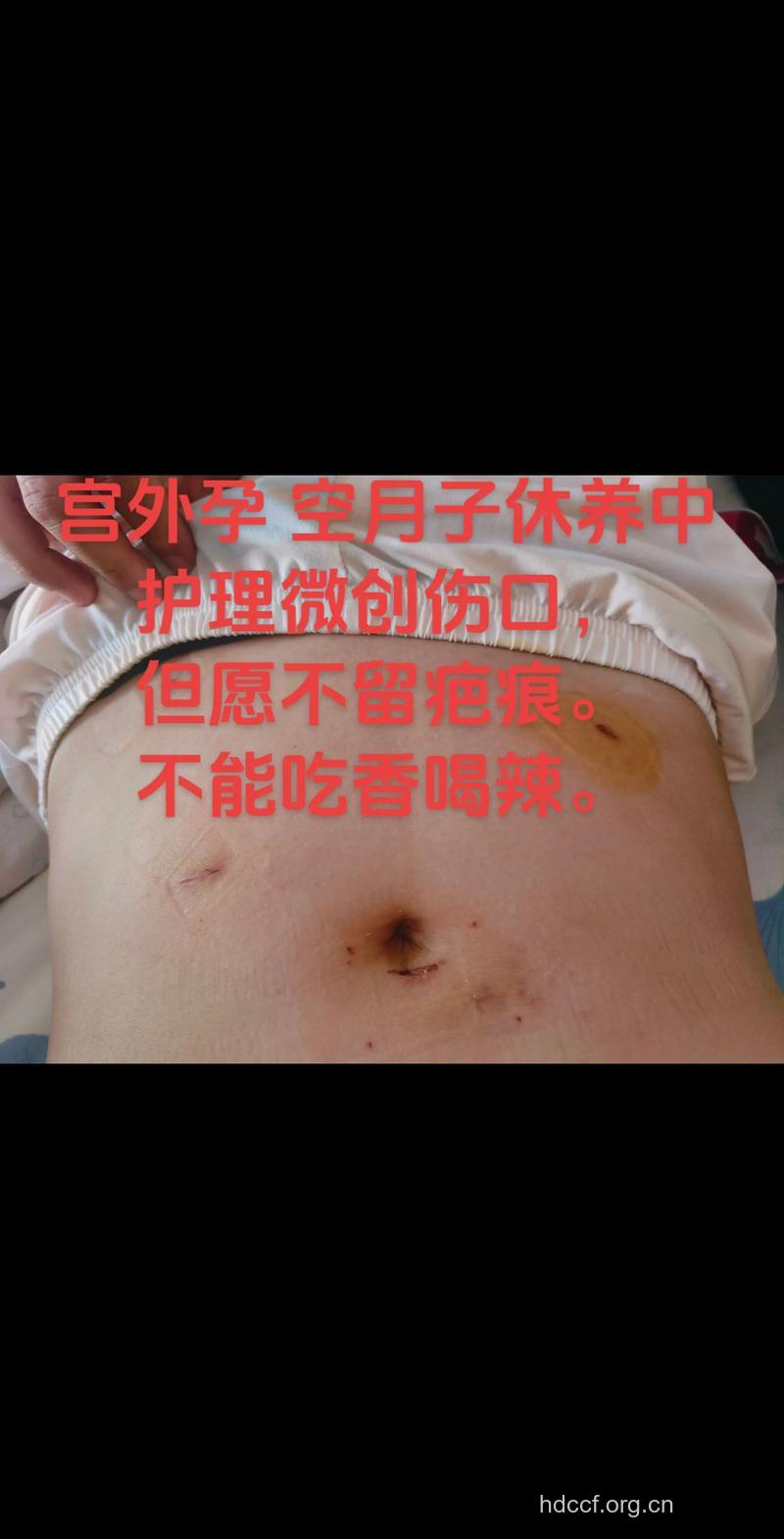 女性引产手术后还能再怀孕吗