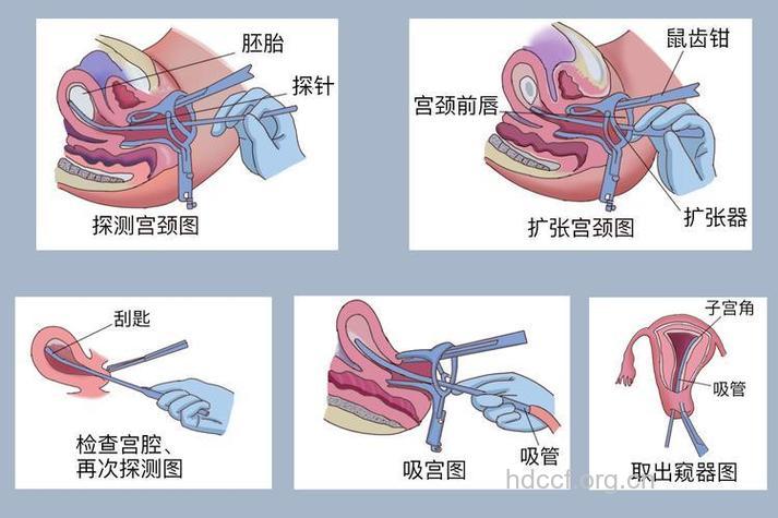 超导可视无痛人流具体步骤 手术分4个流程