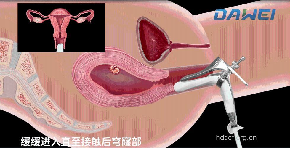 超导可视无痛人流术是什么