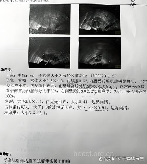 儿子误踢腹部 查出子宫肌瘤