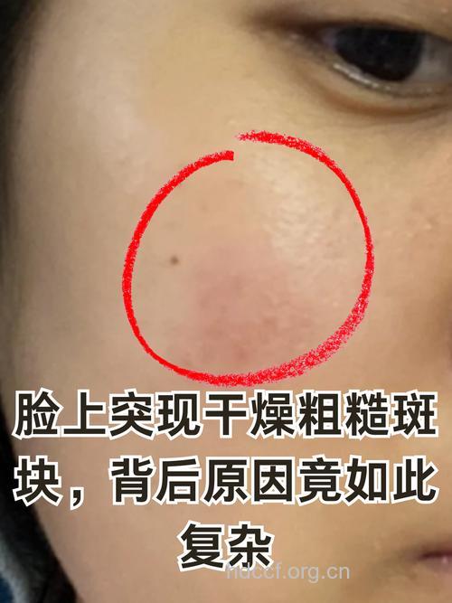 女性经期吵架有这些危害 面部会出现斑点
