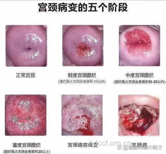 什么是宫颈糜烂