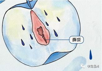 这些情况会导致阴道裂伤 请女人要保护好