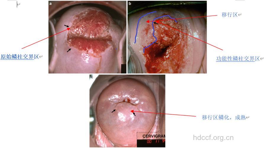 宫颈糜烂的病理真相