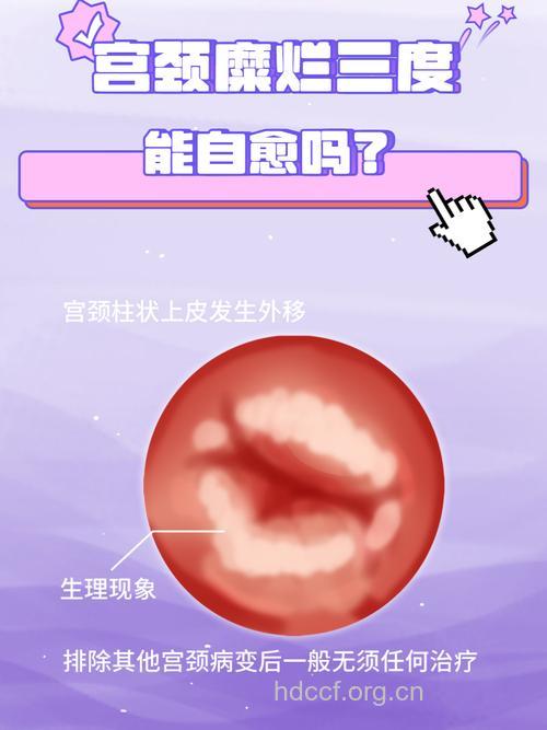 轻度宫颈糜烂可以不治而愈?