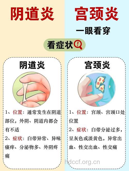 女性健康 六种症状教你识别宫颈炎