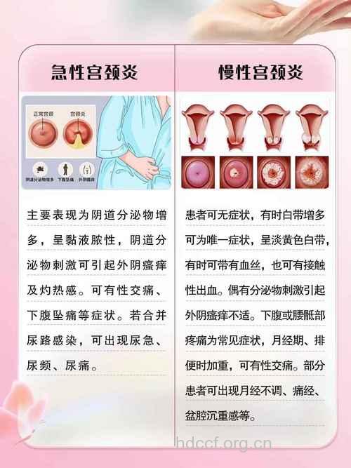 宫颈炎的症状与临床表现
