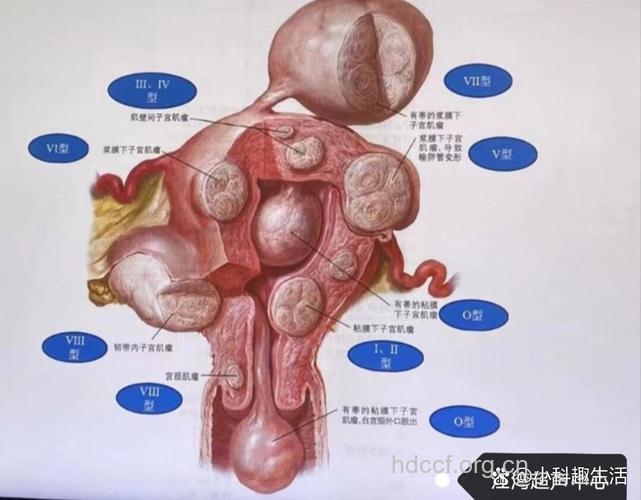 子宫肌瘤可以分为哪些类型