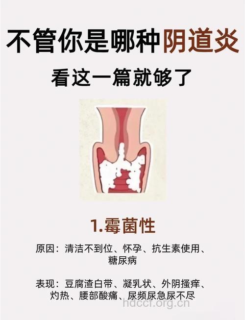 宫颈炎有什么临床表现呢