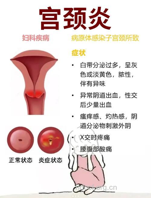 急性宫颈炎症状表现是哪些
