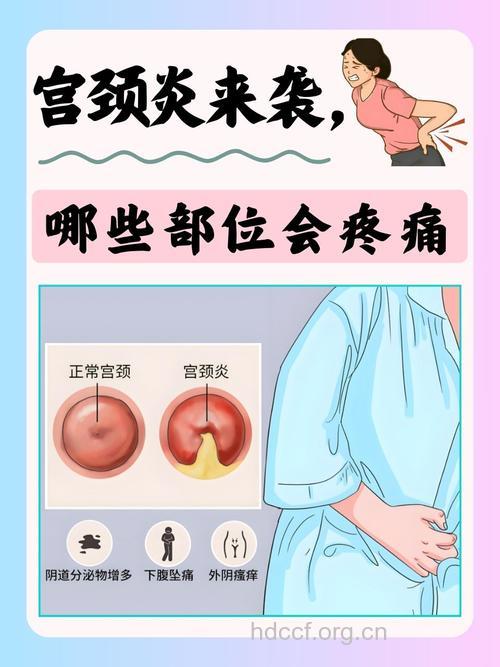 重度宫颈炎的症状是什么