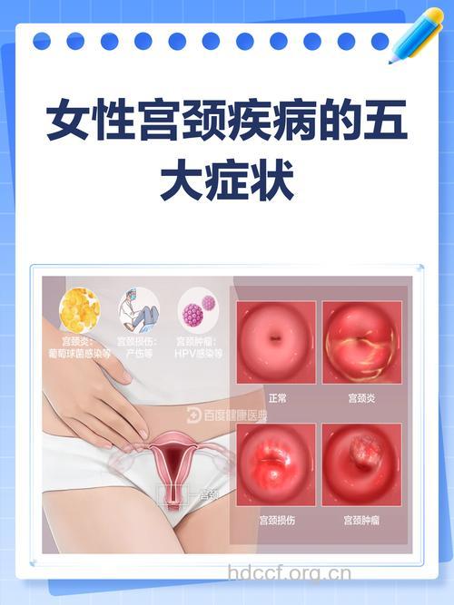 常出现的宫颈炎的症状