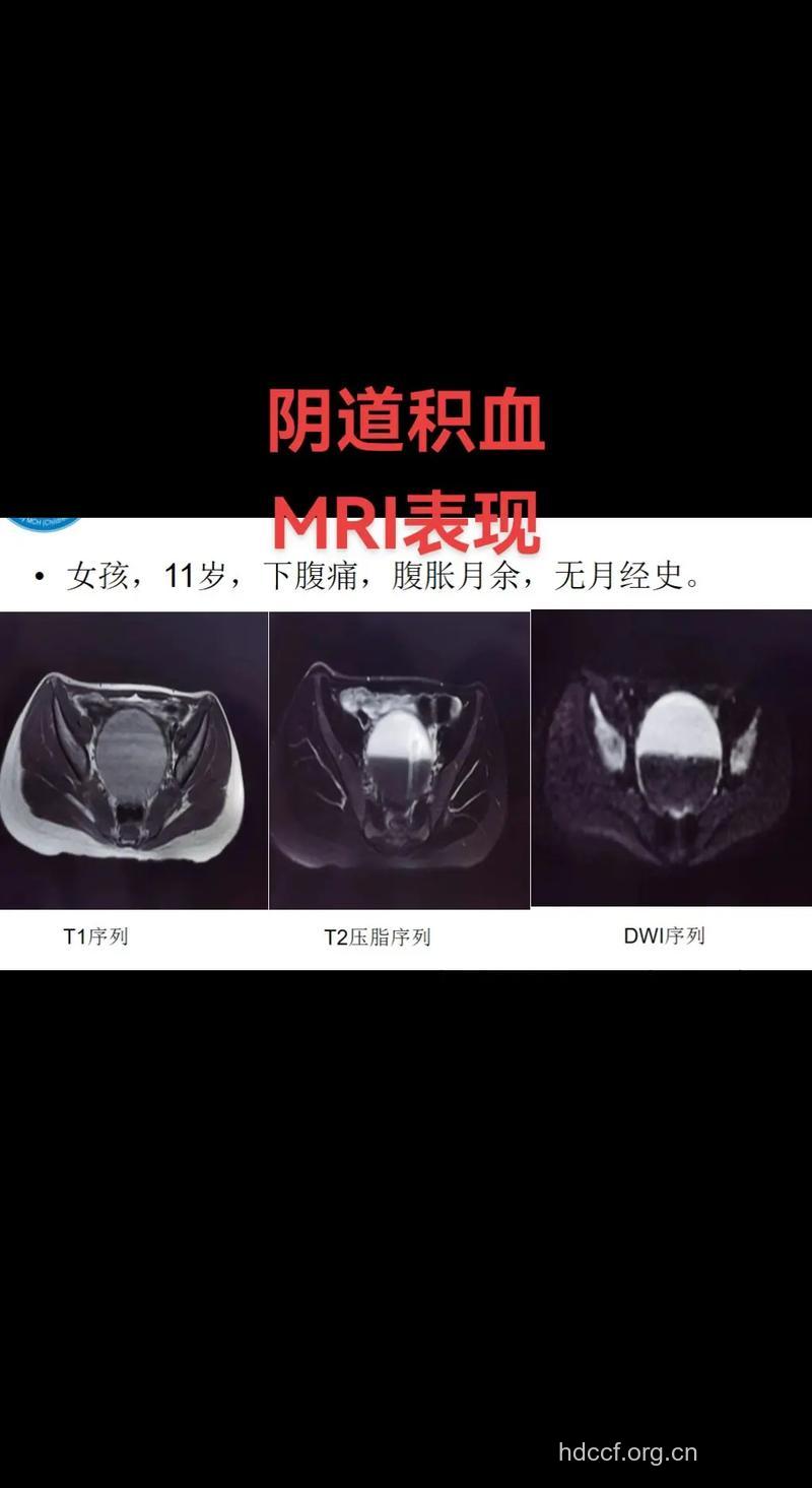 盆腔瘀血症的症状诊断表现