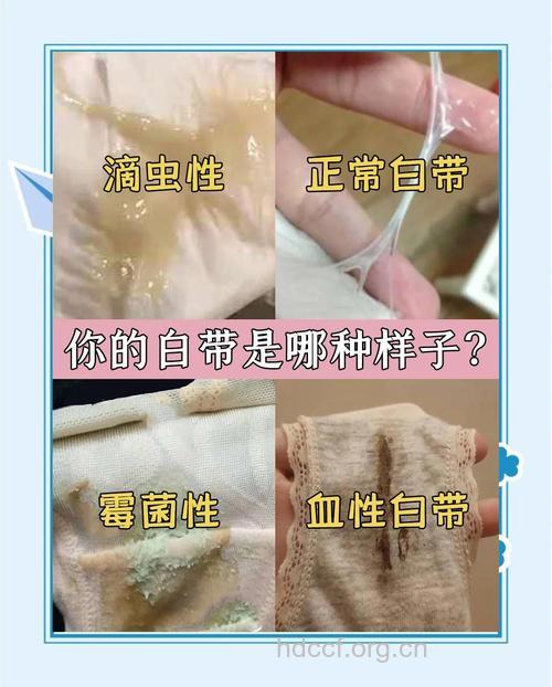 宫颈糜烂白带有哪些异常