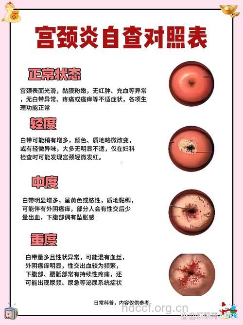 宫颈炎有哪些典型症状