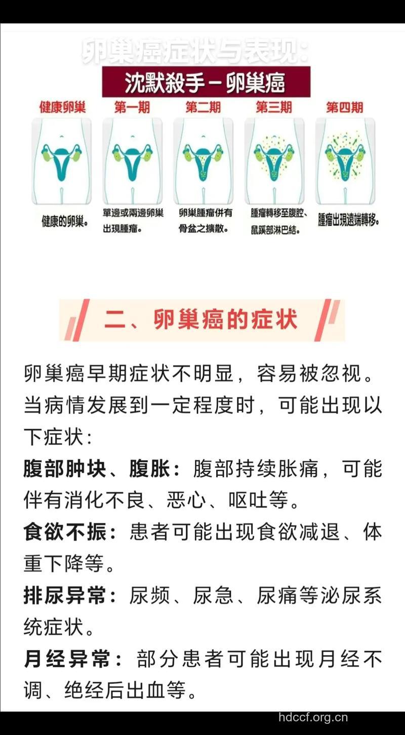 早期卵巢癌的临床表现
