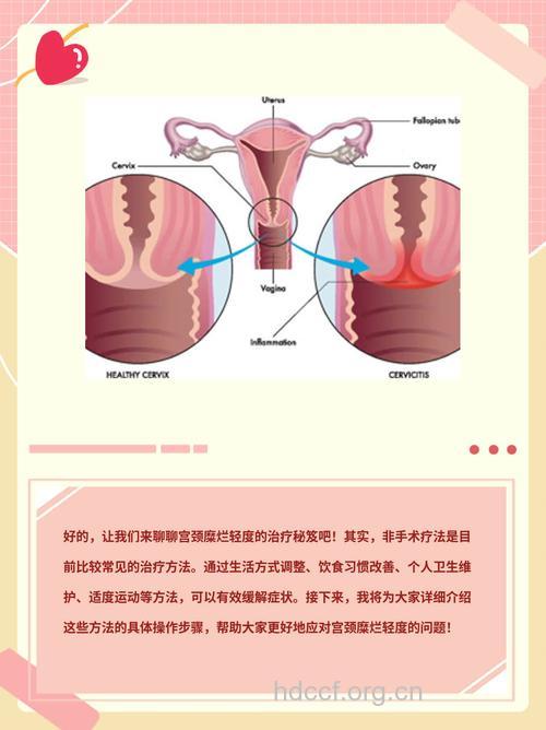 宫颈糜烂的治疗方式