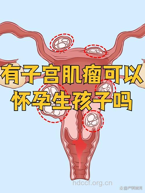 患有子宫肌瘤可以怀孕吗