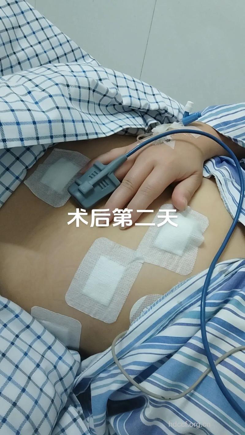 卵巢癌的术后恢复